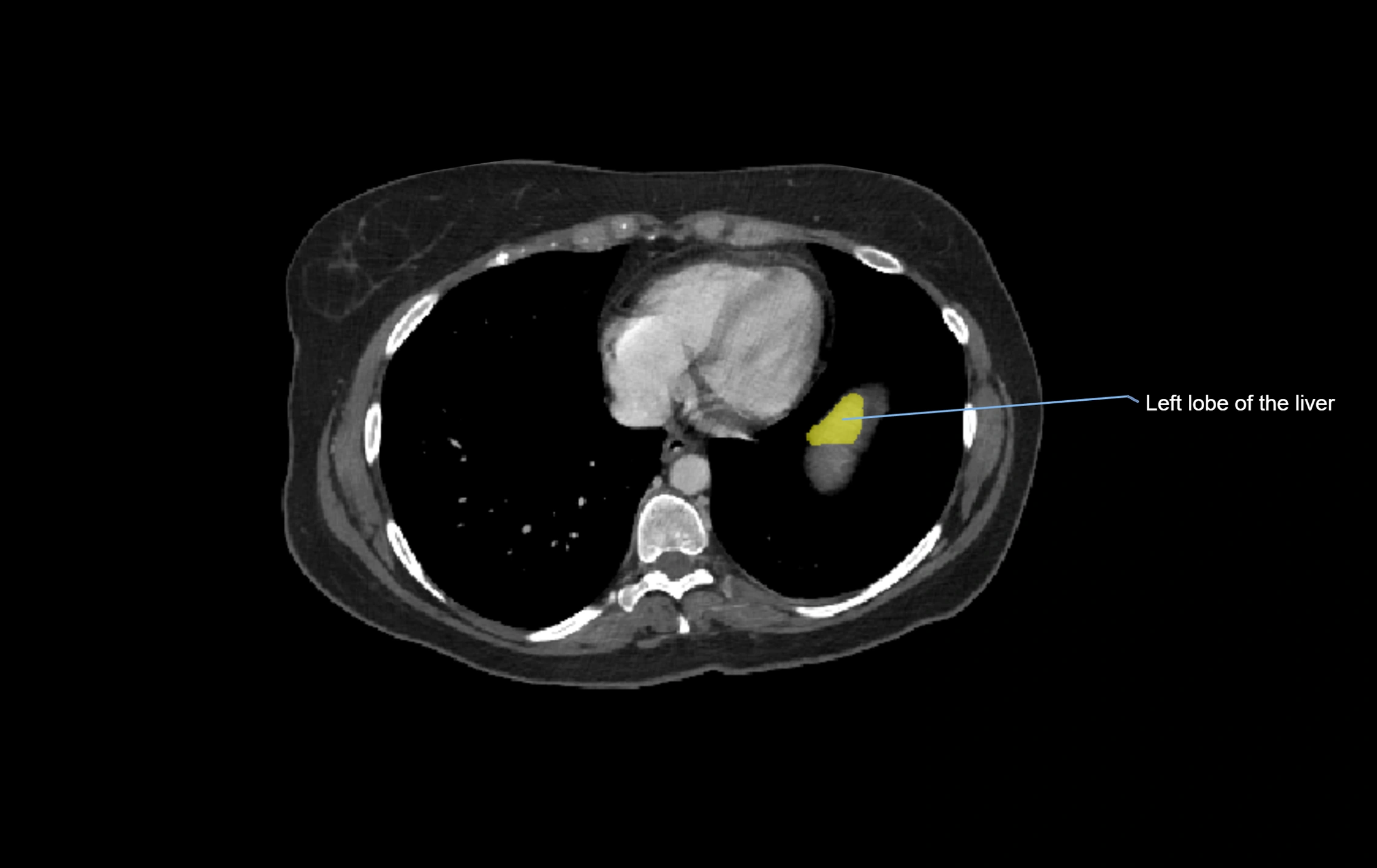 CT lliver lobes axial cross sectional anatomy labelled image -00080.webp